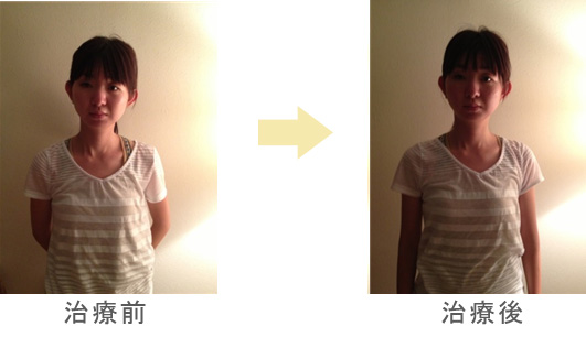 治療前／治療後